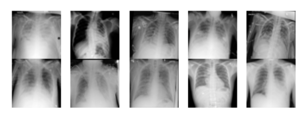 Example chest X-ray images from the RSNA dataset showing normal and pneumonia cases
